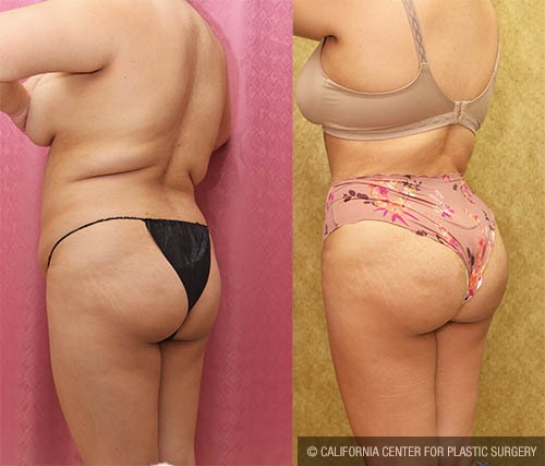 Liposuction of Buttocks Before & After Patient #13688