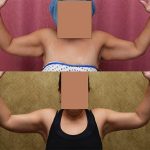 Arm Lift (Brachioplasty) Before & After Patient #13686