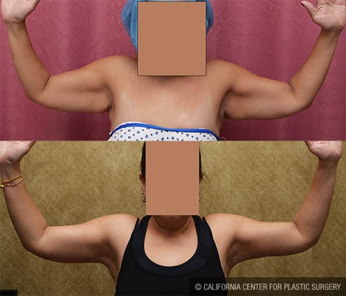 Arm Lift (Brachioplasty) Before & After Patient #13686
