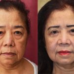 Asian Eyelid Surgery (Blepharoplasty) Before & After Patient #13691