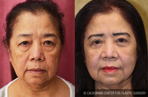 Asian Eyelid Surgery (Blepharoplasty) Before & After Patient #13691