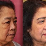 Asian Eyelid Surgery (Blepharoplasty) Before & After Patient #13691