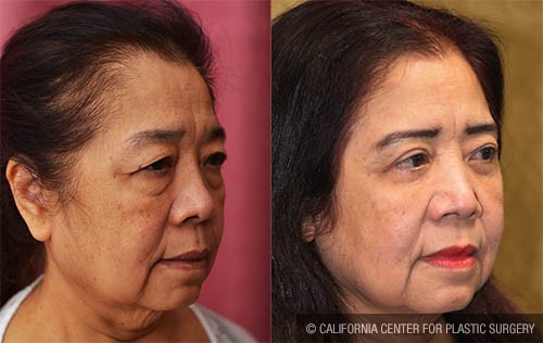 Asian Eyelid Surgery (Blepharoplasty) Before & After Patient #13691