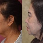 Asian Eyelid Surgery (Blepharoplasty) Before & After Patient #13691