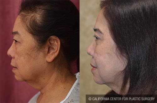 Asian Eyelid Surgery (Blepharoplasty) Before & After Patient #13691