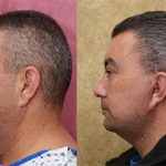 Facelift Before & After Patient #13693