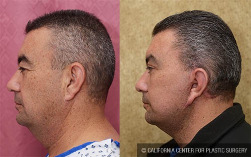 Facelift Before & After Patient #13693