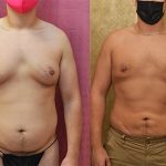 Male gynecomastia (breast) reduction Before & After Patient #13698