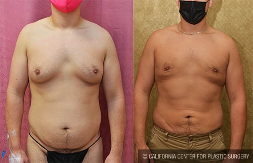 Male gynecomastia (breast) reduction Before & After Patient #13698