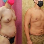 Male gynecomastia (breast) reduction Before & After Patient #13698