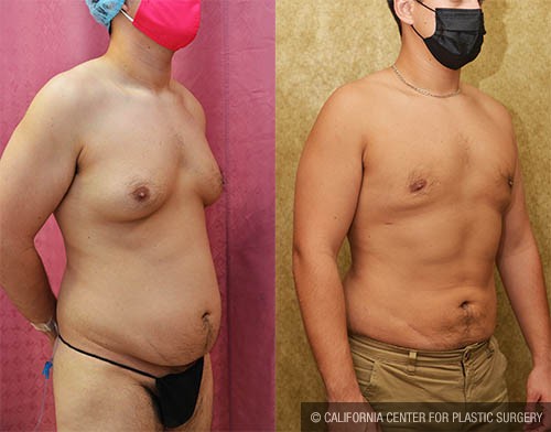 Male gynecomastia (breast) reduction Before & After Patient #13698
