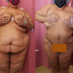 Body Lift Before & After Patient #13809