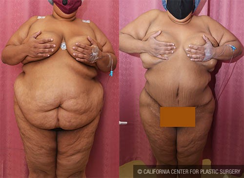 Body Lift Before & After Patient #13809
