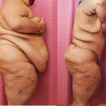 Body Lift Before & After Patient #13809