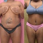 Tummy Tuck (Abdominoplasty) Medium Size Before & After Patient #13709