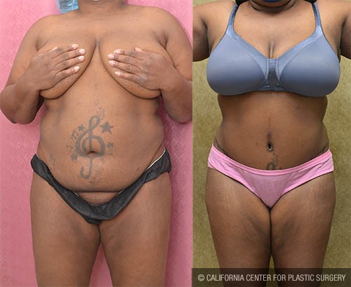 Tummy Tuck (Abdominoplasty) Medium Size Before & After Patient #13709