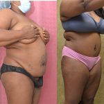 Tummy Tuck (Abdominoplasty) Medium Size Before & After Patient #13709