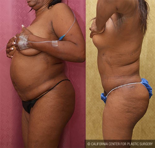 Tummy Tuck (Abdominoplasty) Small Size Before & After Patient #13706