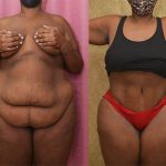 Tummy Tuck (Abdominoplasty) Super Plus Size Before & After Patient #13707