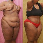 Tummy Tuck (Abdominoplasty) Super Plus Size Before & After Patient #13707