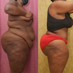 Tummy Tuck (Abdominoplasty) Super Plus Size Before & After Patient #13707