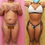 Tummy Tuck (Abdominoplasty) Small Size Before & After Patient #13812