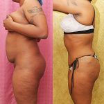 Tummy Tuck (Abdominoplasty) Small Size Before & After Patient #13812