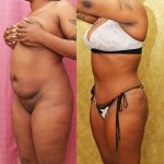 Tummy Tuck (Abdominoplasty) Small Size Before & After Patient #13812