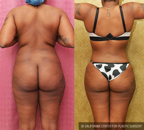 Tummy Tuck (Abdominoplasty) Small Size Before & After Patient #13812