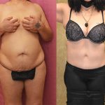 Tummy Tuck (Abdominoplasty) Medium Size Before & After Patient #13710