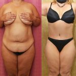 Tummy Tuck (Abdominoplasty) Medium Size Before & After Patient #13813