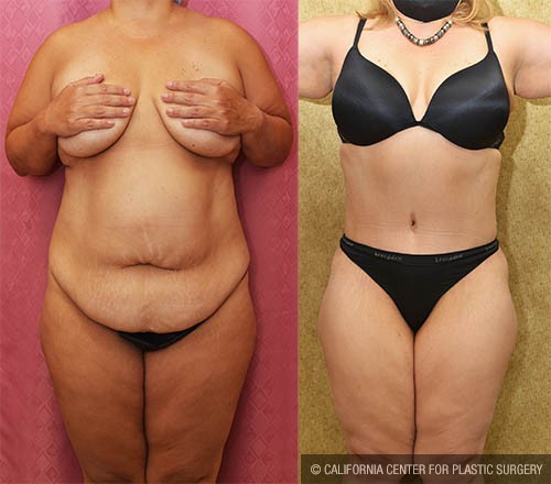 Tummy Tuck (Abdominoplasty) Medium Size Before & After Patient #13813