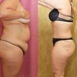 Tummy Tuck (Abdominoplasty) Medium Size Before & After Patient #13813
