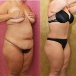 Tummy Tuck (Abdominoplasty) Medium Size Before & After Patient #13813