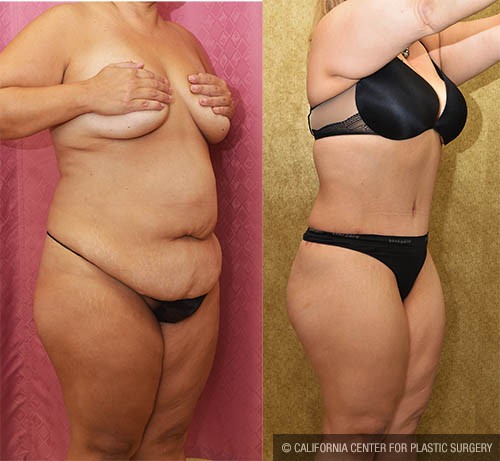 Tummy Tuck (Abdominoplasty) Medium Size Before & After Patient #13813