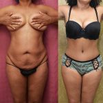 Tummy Tuck (Abdominoplasty) Small Size Before & After Patient #13703