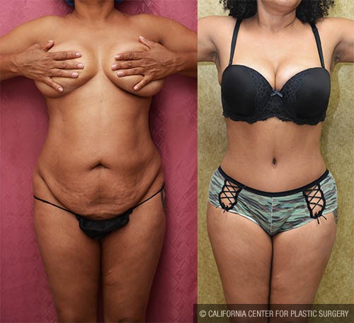 Tummy Tuck (Abdominoplasty) Small Size Before & After Patient #13703