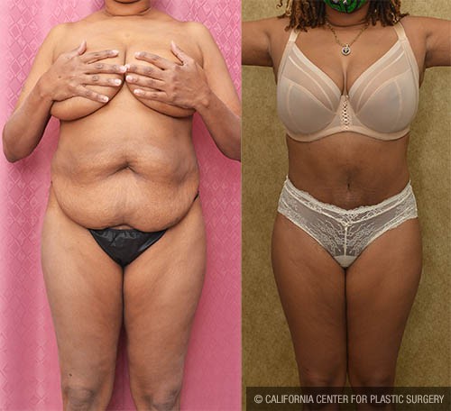 Tummy Tuck (Abdominoplasty) Small Size Before & After Patient #13705
