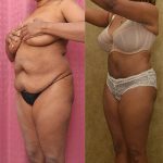 Tummy Tuck (Abdominoplasty) Small Size Before & After Patient #13705