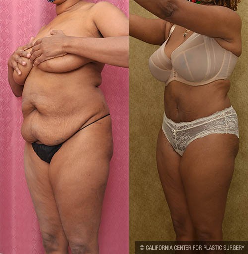 Tummy Tuck (Abdominoplasty) Small Size Before & After Patient #13705