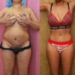 Tummy Tuck (Abdominoplasty) Small Size Before & After Patient #13811