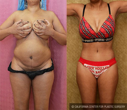 Tummy Tuck (Abdominoplasty) Small Size Before & After Patient #13811