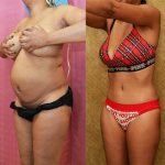 Tummy Tuck (Abdominoplasty) Small Size Before & After Patient #13811