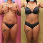 Tummy Tuck (Abdominoplasty) Small Size Before & After Patient #13708