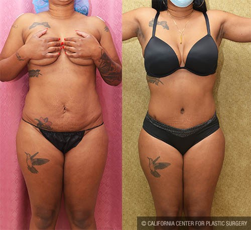 Tummy Tuck (Abdominoplasty) Small Size Before & After Patient #13708