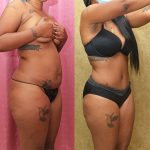 African American Tummy Tuck (Abdominoplasty) Before & After Patient #13708