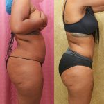 African American Tummy Tuck (Abdominoplasty) Before & After Patient #13708