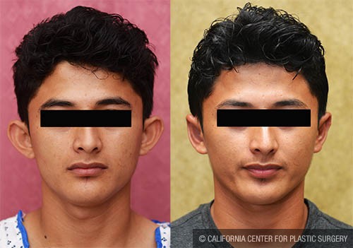 Ear (Otoplasty) Before & After Patient #13819