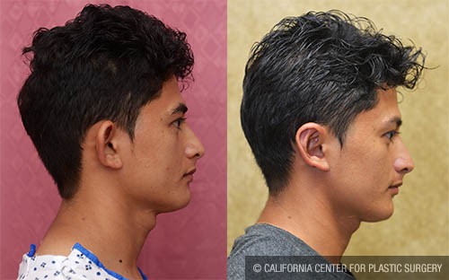 Ear (Otoplasty) Before & After Patient #13819