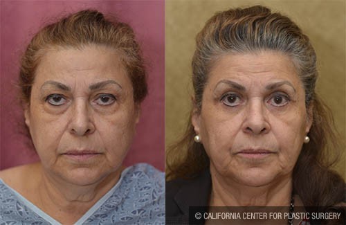 Eyelid (Blepharoplasty) Before & After Patient #13690